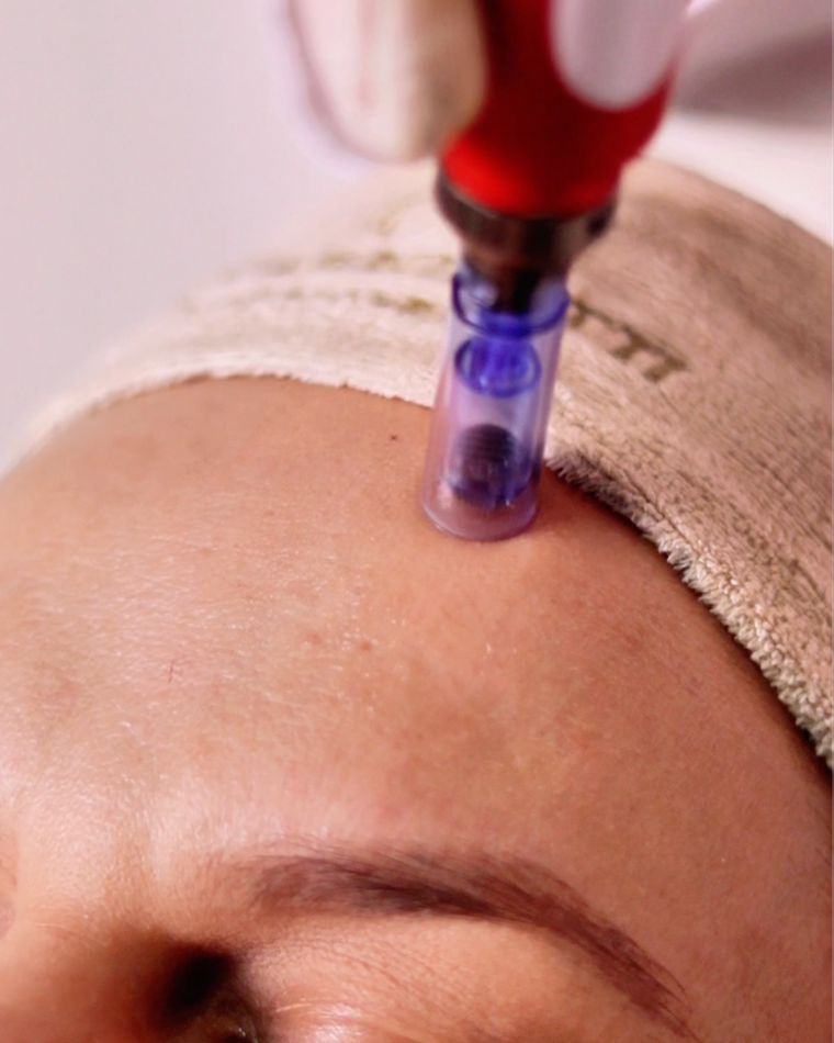 Microagulhamento Facial