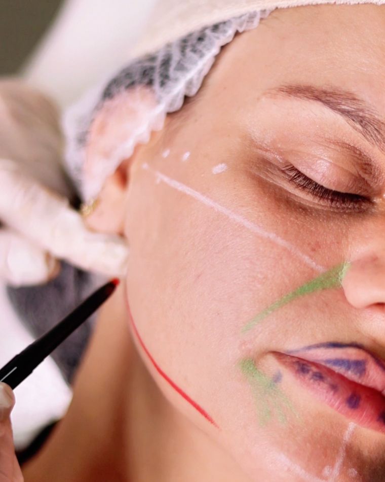 Preenchimento facial com ácido hialurônico