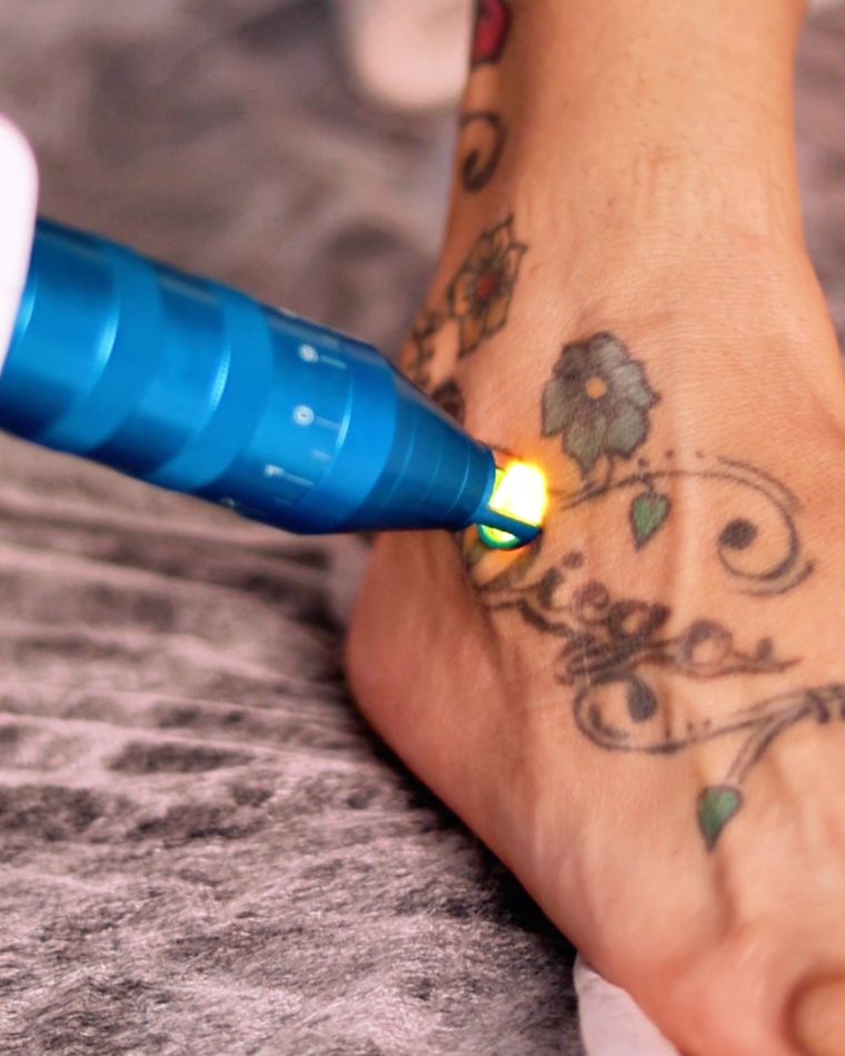 Remoção de Tatuagem