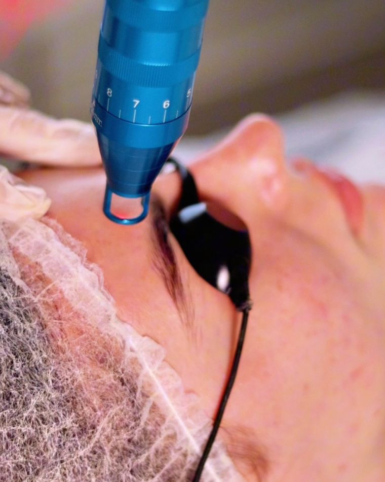Remoção de Micropigmentação
